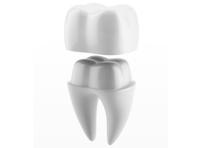 Fractured or Cracked Tooth: Think of a Crown