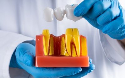 Learn About Dental Bridges