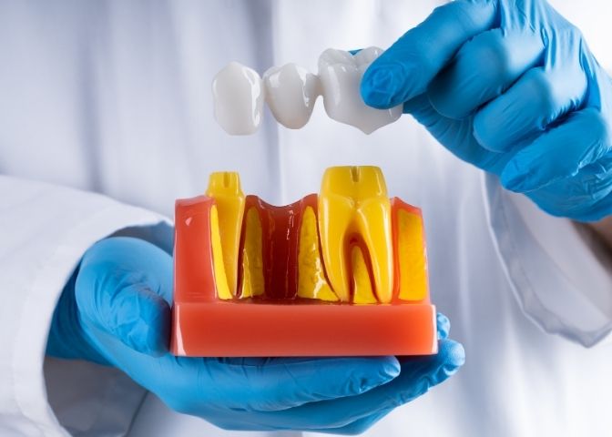 Learn About Dental Bridges