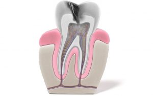 endodontics - root canal procedure