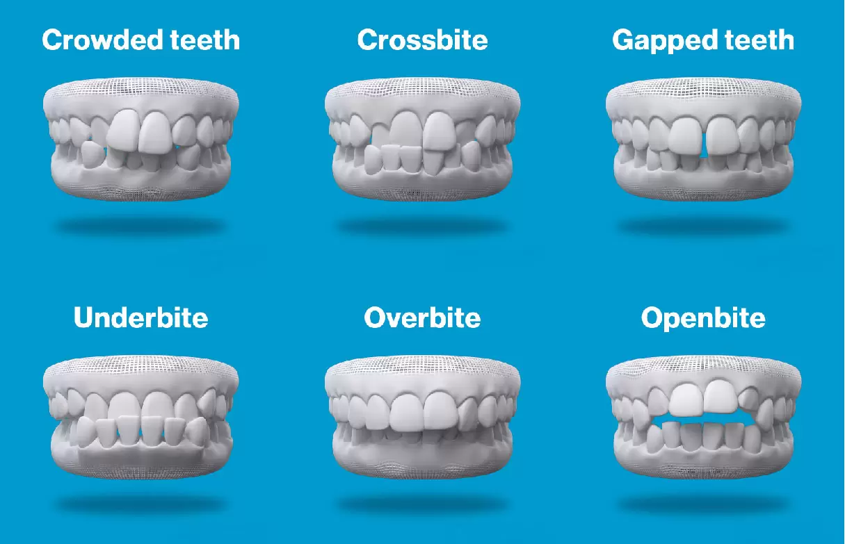 invisalign treatable cases