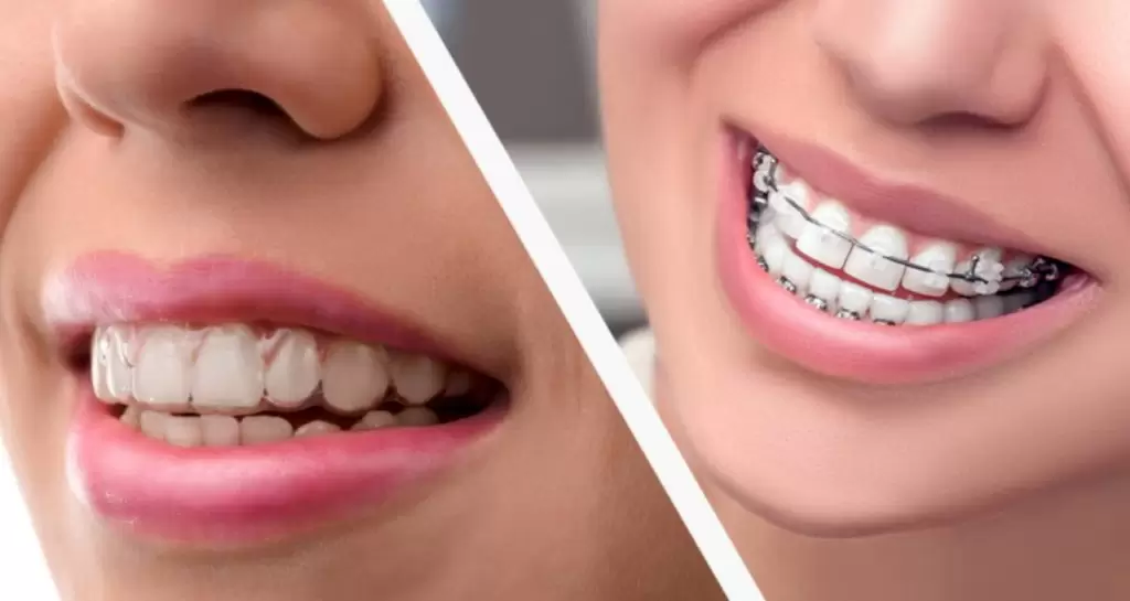 Invisalign Vs Braces - Which Is The Best Orthodontic Treatment For Your  Smile - Sandy Smiles Orthodontics