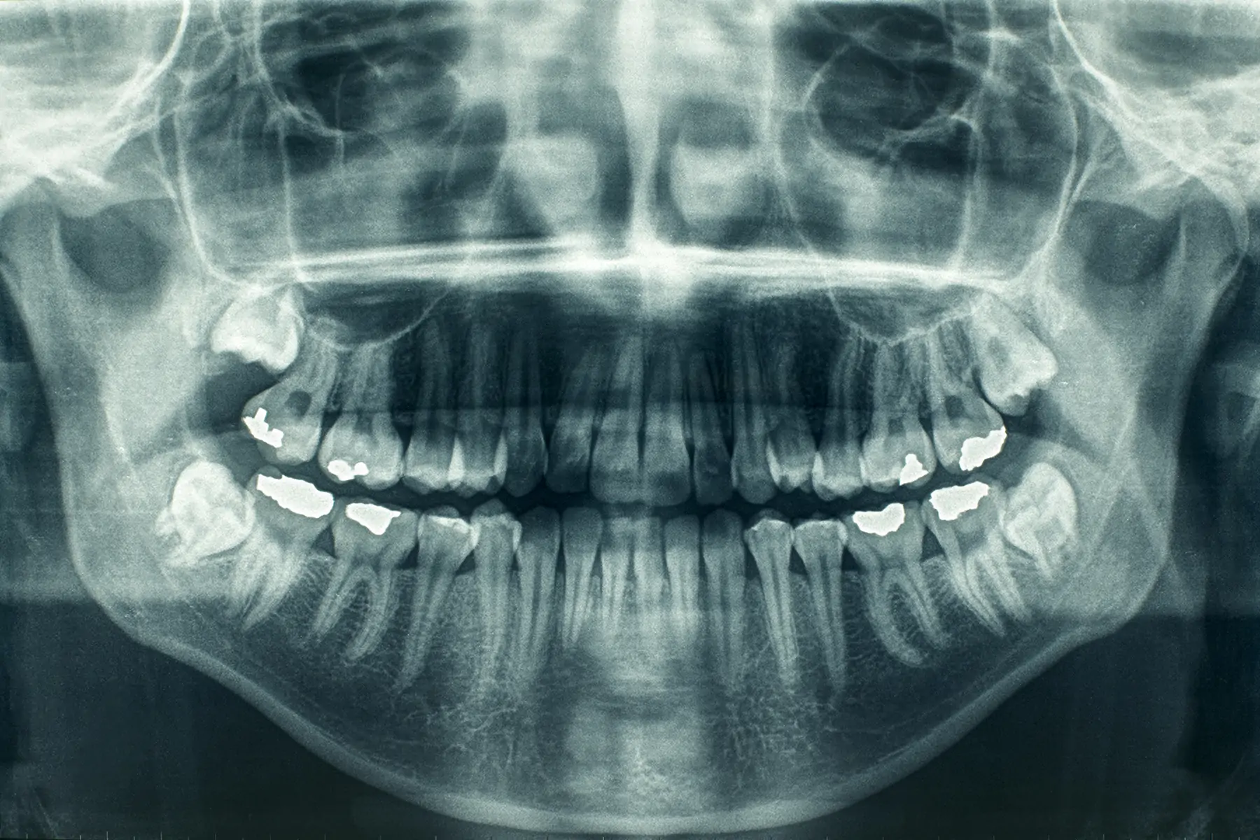 impacted wisdom teeth xray